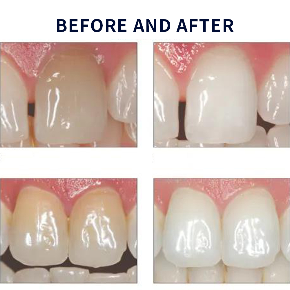 Opalescence Whitening 20% PF 2 - Teeth Whitening Home Kit ulasan dan harga
