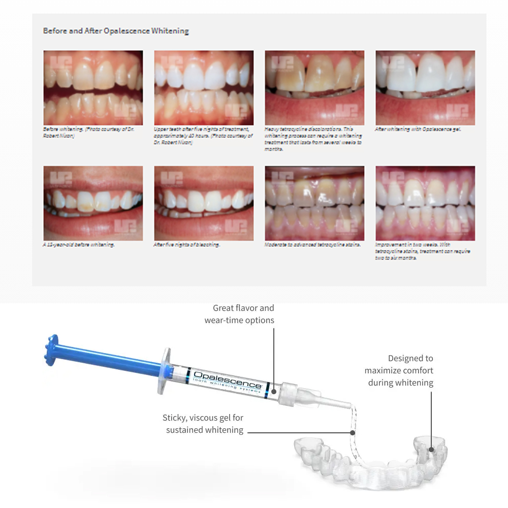 Opalescence Whitening 20% PF 2 - Teeth Whitening Home Kit ulasan dan harga