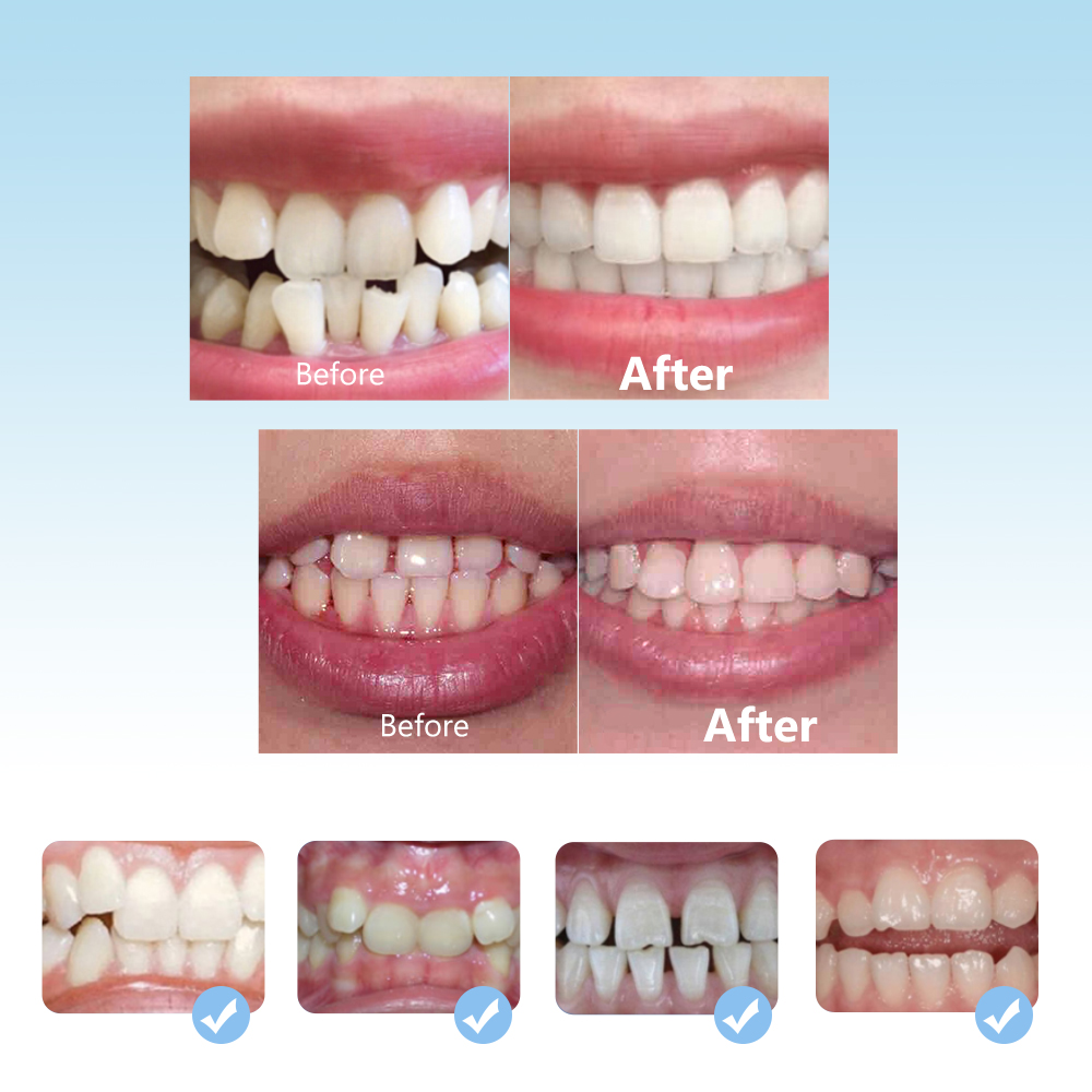 Dental Orthodontic Braces Set  - Teeth Whitening Mouth Guard ulasan dan harga