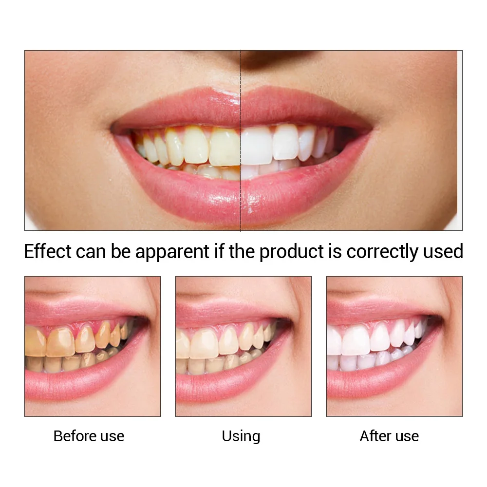 FTEENPLY Teeth Whitening Essen - Teeth Whitening From Home ulasan dan harga