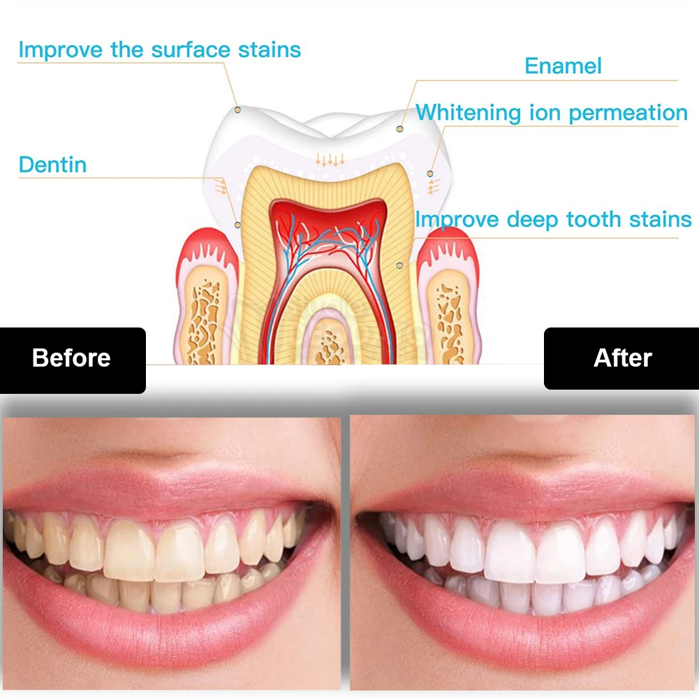 Dental Teeth Whitening Kit Min - Teeth Whitening Gels Used By Dentists ulasan dan harga