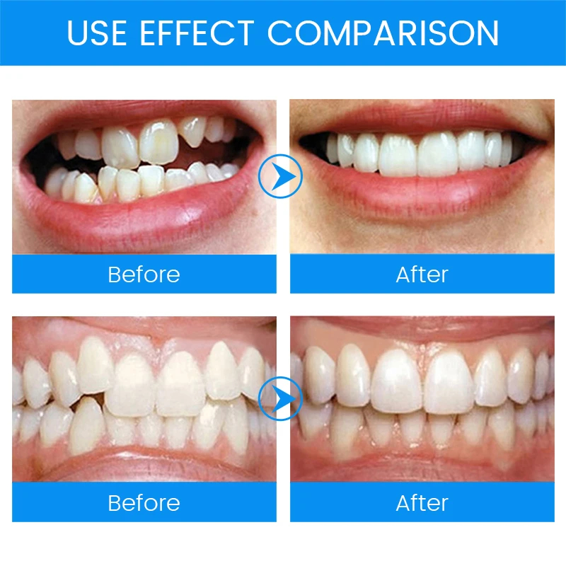 3 Stages Dental Orthodontic Br - Teeth Whitening Mouth Guard ulasan dan harga
